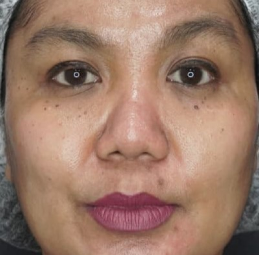 Before/After Image
